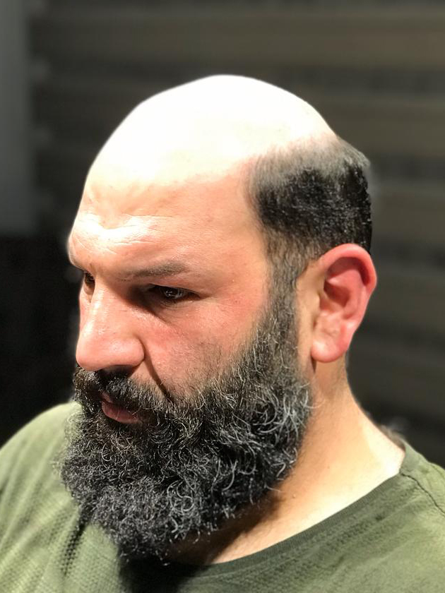 Erkek Protez Saç