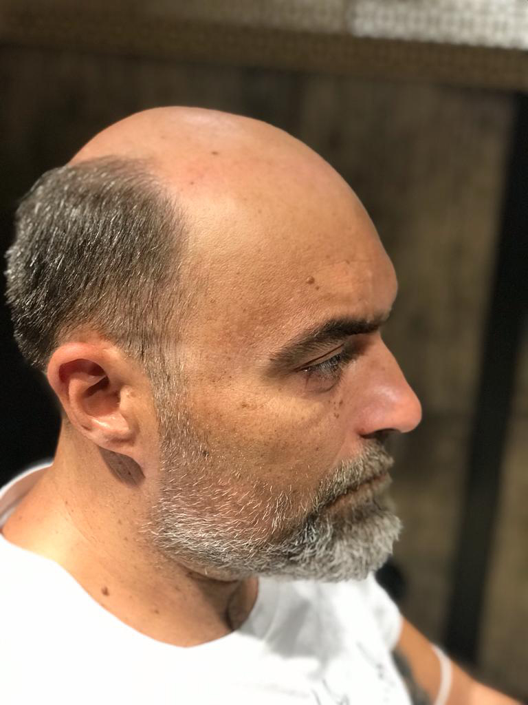 İstanbul Protez Saç